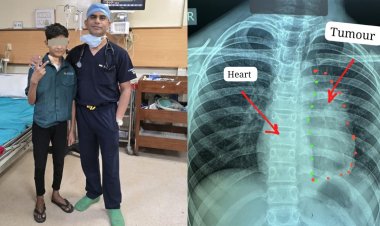 रायपुर : अम्बेडकर अस्पताल में 11 साल के बच्चे के दिल से चिपका दुर्लभ कैंसर निकाला, बना विश्व कीर्तिमान